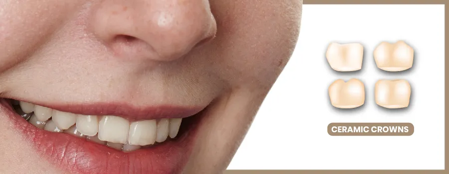All-ceramic-all-porcelain-crowns.webp