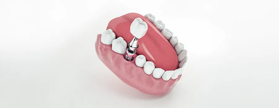 Best-Dental-Implant-Brands-in-Turkey.webp