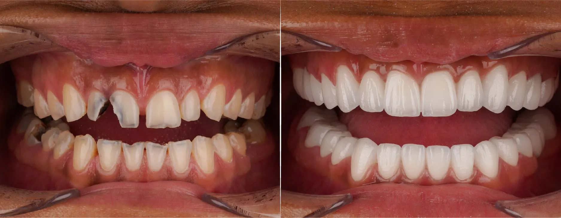 Chipped-front-teeth-before-and-after.webp