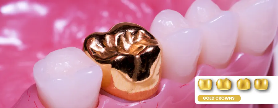 Gold-dental-crowns.webp