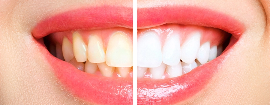 Teeth-Body.webp