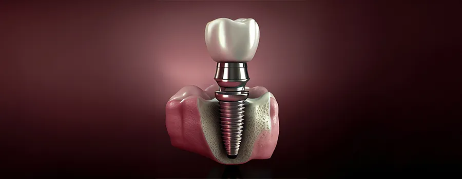 all-on-six-dis-implant.webp
