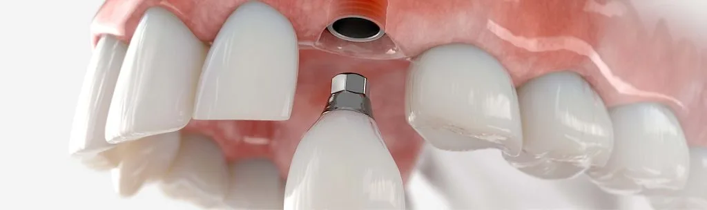 an-implant-here-that-is-inserted-into-the-jawbone--1024x304.webp