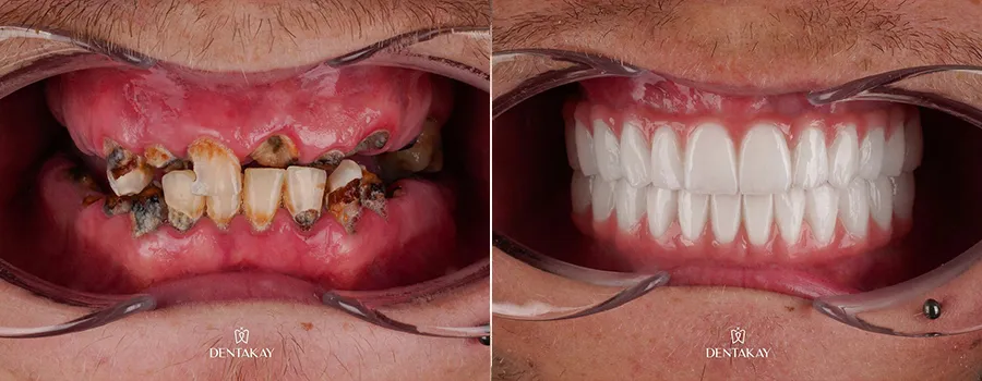before-after.webp