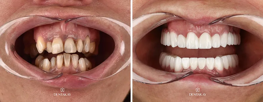 crooked-teeth.webp