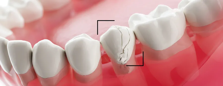 damaged-dental-crown-needs-to-be-repaired.webp