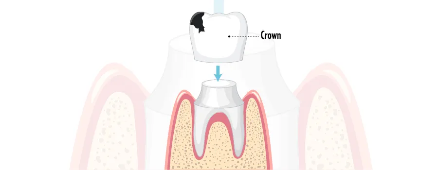 dental-crowns-dangers-crown-fracture.webp