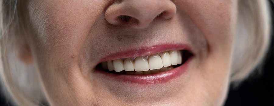 dental-implants-for-front-teeth.webp