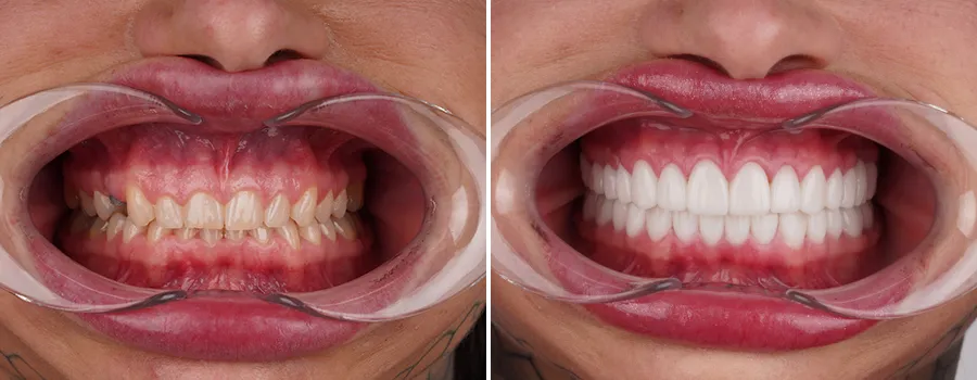 misha-morley-emax-before-after-dentakay-1.webp
