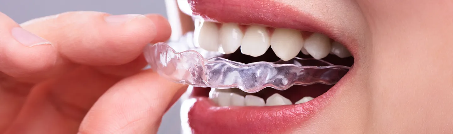 night-guard-for-bruxism.webp