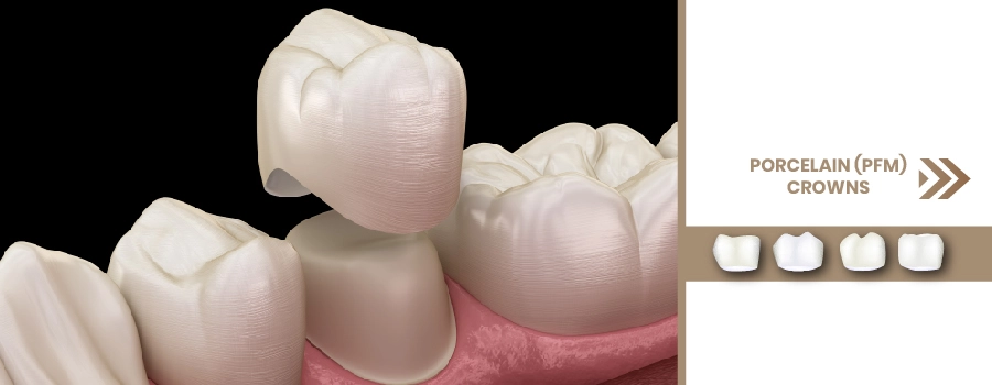 porcelain-fused-to-metal-pfm-crowns1.webp