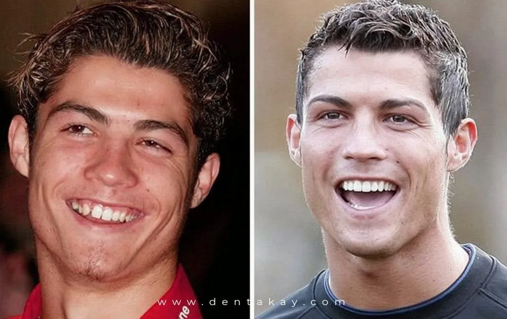 ronaldoteeth-1024x645.webp