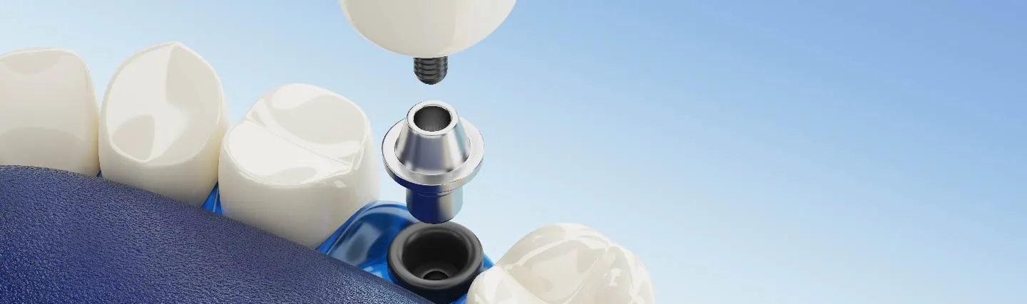what-is-an-abutment-for-dental-implant-1.webp