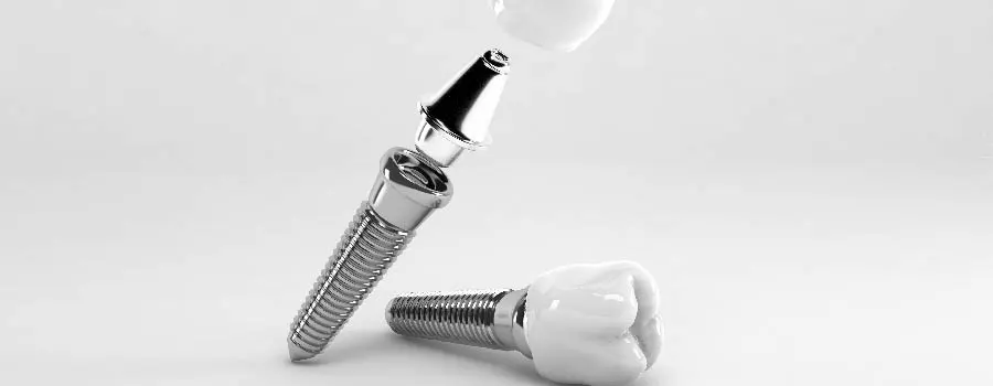 what-makes-abutments-so-important-1.webp
