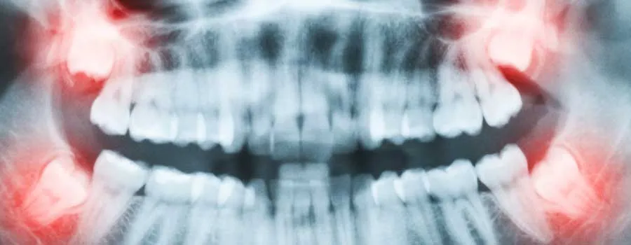 where-are-wisdom-teeth-located-.webp