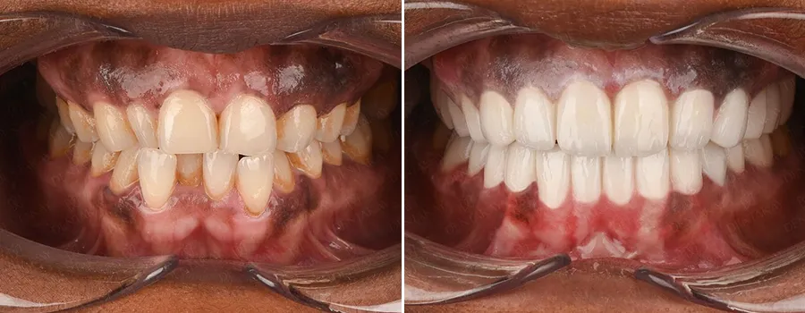 zirconia-crowns.webp