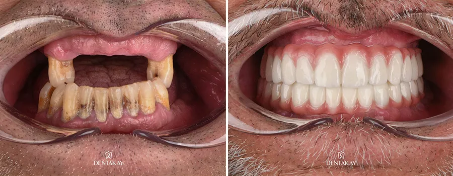 zygomatic-implants.webp